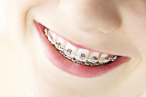 Braces in Lanier Heights