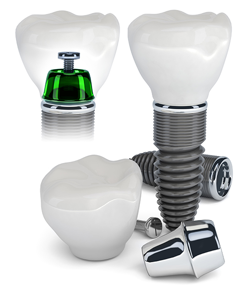 Dental Implant Lanier Heights