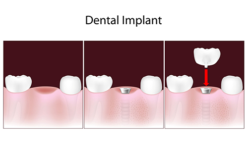 Columbia Heights Dental Implant