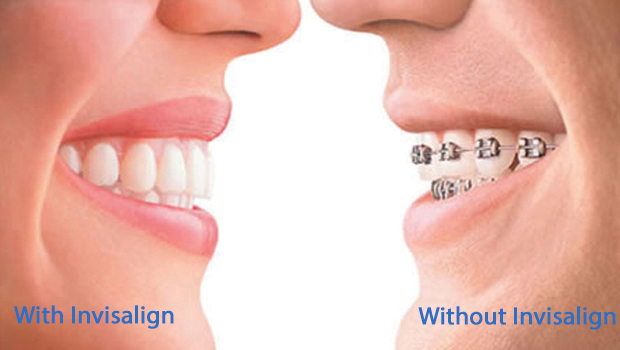 Lanier Heights Invisalign Dentist