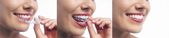 Invisalign Dentist Columbia Heights